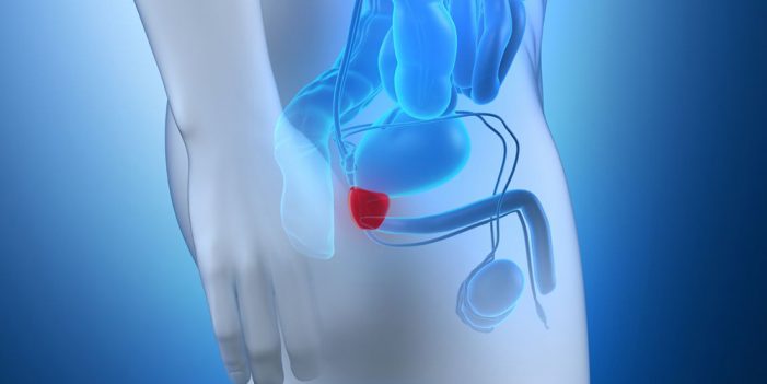 Invita Secretaría de Salud a prueba de cáncer prostático